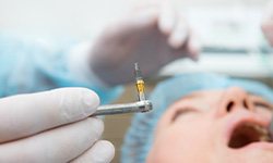 Closeup of a dental implant about to be placed in patient’s mouth