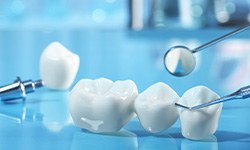 Dental implant, crown, and bridge on reflective blue surface