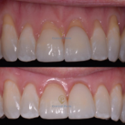 Closeup of smile before and after surgical periodontal therapy
