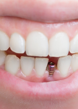 A person with a dental implant