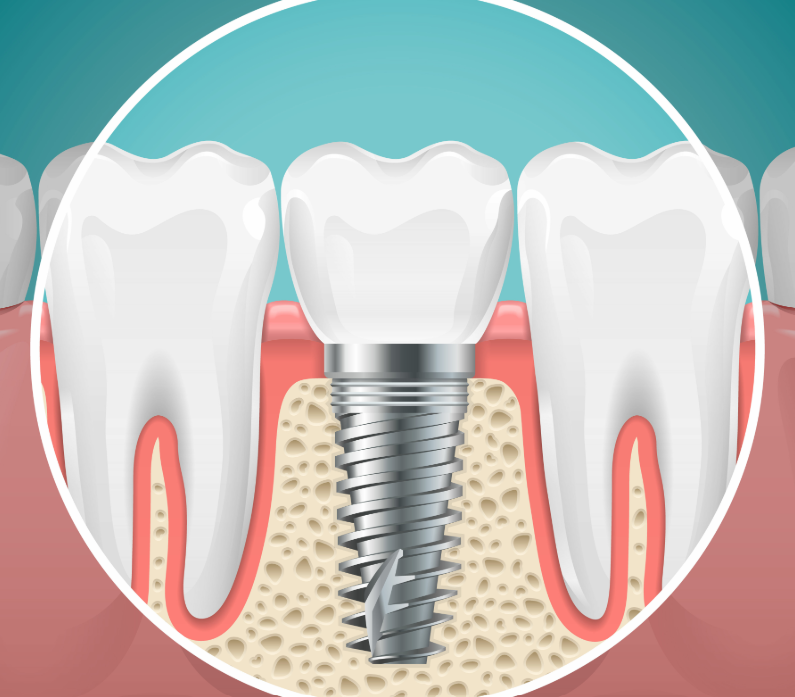 Illustrated cross section of a dental implant